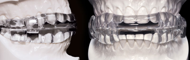 Why Neuromuscular Dentistry and the TENS unit - Adler Cosmetic & Family  Dentistry