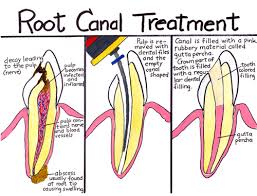 The Root Canal Controversey
